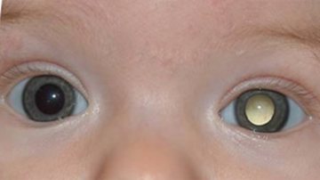 Leucoria é um dos sinais visuais de retinoblastoma. - Elord/wikidoc.org