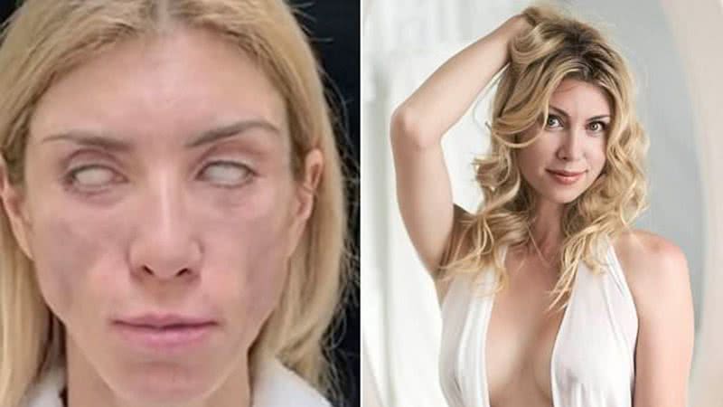 Miss russa não consegue fechar os olhos após procedimento cirúrgico. - Daily Mail