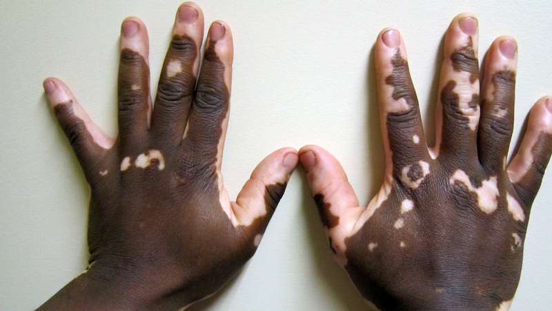 Vitiligo é a doença de pele de Natália, do BBB 22 - Reprodução/Wikipedia