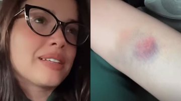 Juliette surge cheia de hematomas após passeio e se explica - Instagram/@juliette