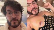 Eliezer realizou uma ginecomastia, que é uma cirurgia comum entre os homens - Instagram/Eliezer
