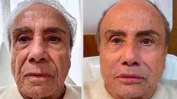 Stênio Garcia realizou uma harmonização facial em junho de 2023 - Reprodução / Instagram