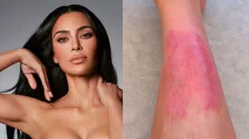 Saiba o que é psoríase, doença que afeta Kim Kardashian - Reprodução/Instagram