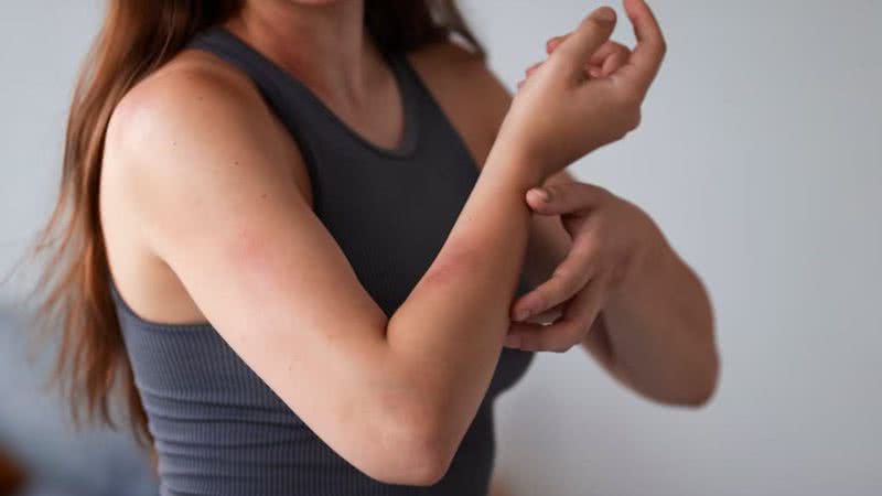 Lúpus provoca lesões na pele - Freepik