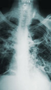 Agosto Branco e o câncer de pulmão