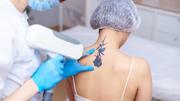Procedimento estético pode remover completamente as tatuagens - ViktoriiaNovokhatska | Shutterstock