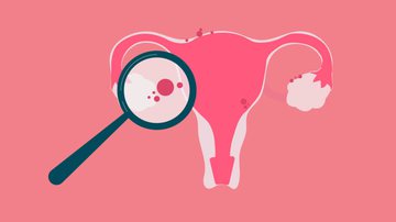 A endometriose é uma doença de origem inflamatória - Shutterstock