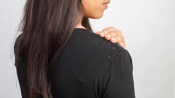 A dermatite seborreia atinge 50% da população - Shutterstock