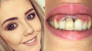Aoife Wills teve queimaduras nos dentes após um clareamento dental mais em conta - Facebook/ Aoife Wills