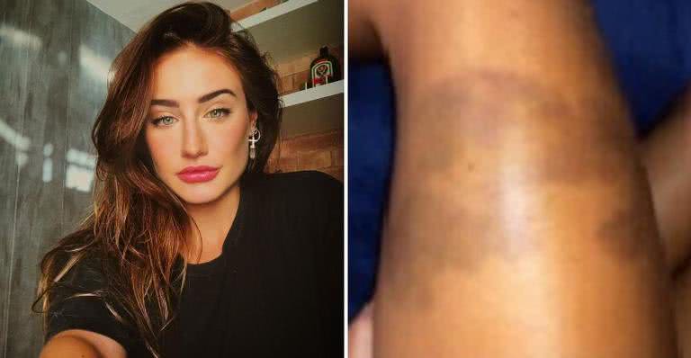 Bruna Griphao explicou o hematoma na perna - Instagram/@brunagriphaoo