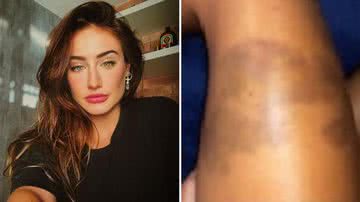 Bruna Griphao explicou o hematoma na perna - Instagram/@brunagriphaoo