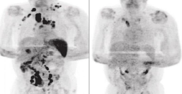 Exame de tomografia do paciente que mostra o alívio nos tumores - Divulgação/ British Journal of Haematology