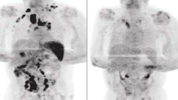 Exame de tomografia do paciente que mostra o alívio nos tumores - Divulgação/ British Journal of Haematology