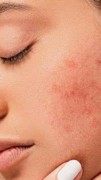 5 dicas para amenizar a acne
