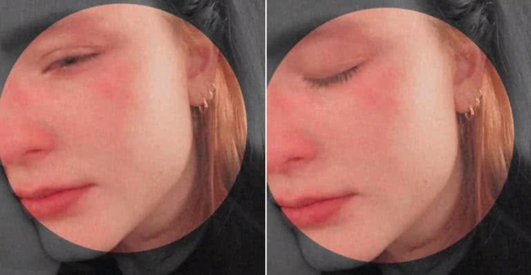 Larissa Manoela surge com olhos inchados e rosto vermelho em Instagram Stories - Instagram/@larissamanoela