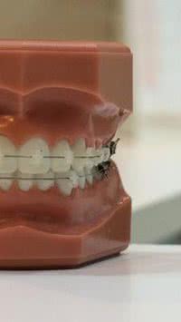 Como limpar o aparelho dental corretamente?