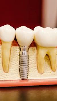 Mitos e verdades do implante dentário