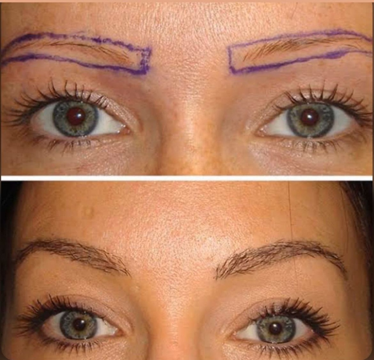 Antes e depois de um transplante de sobrancelhas; na prmeira foto, a região apresenta falhas, enquanto na segunda ela aparece preenchida