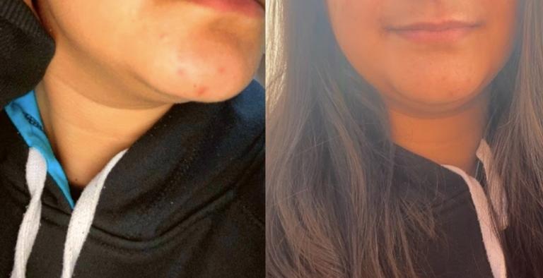 Antes e depois, com cerca de uma semana de uso do Skinceuticals Phyto Corrective. (Crédito: Ana Luiza Xavier)